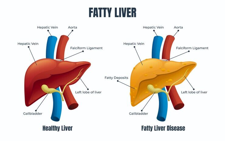  All You Need to Know about Fatty Liver Disease
