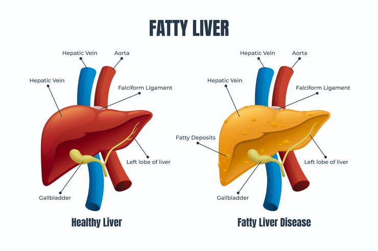 All You Need to Know about Fatty Liver Disease