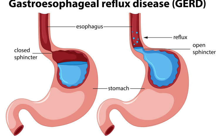  What Should You Know About Acid Reflux (GERD)?