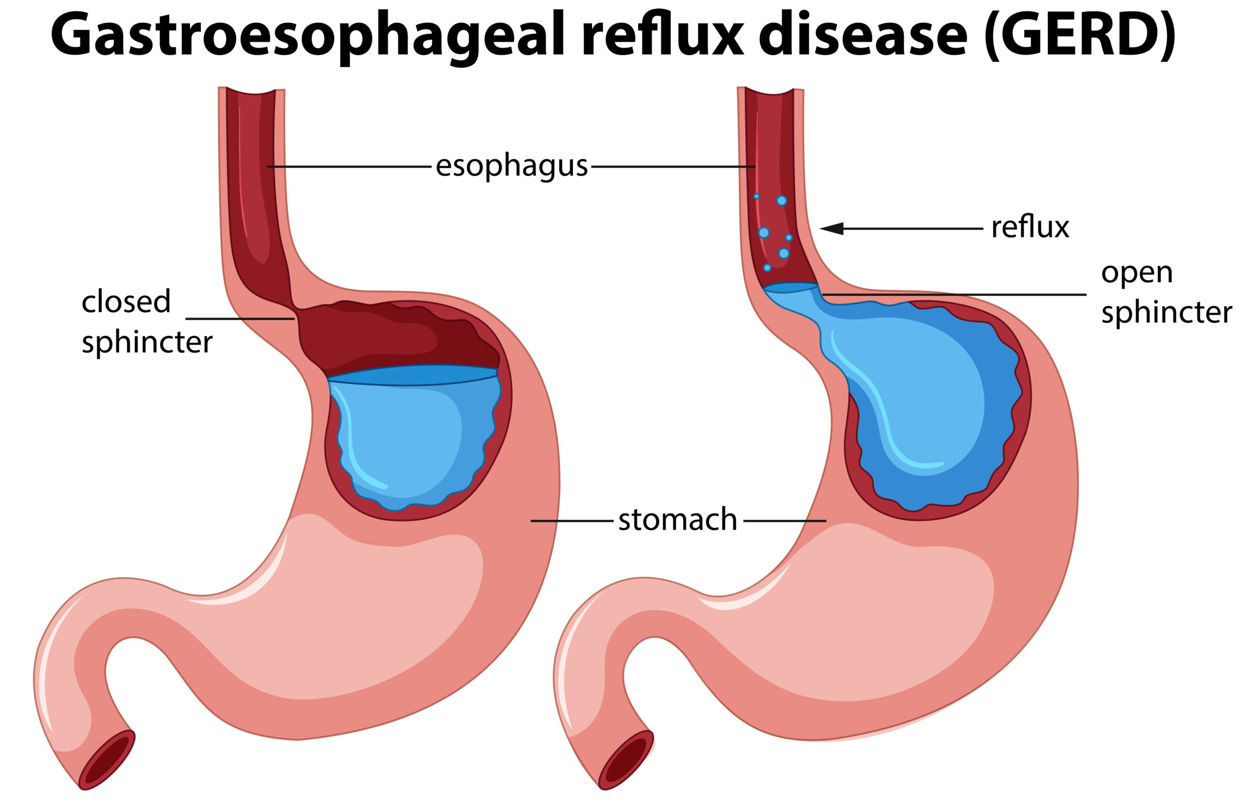 Nursing Paper Example on Gastroesophageal reflux disease (GERD) [SOLVED]