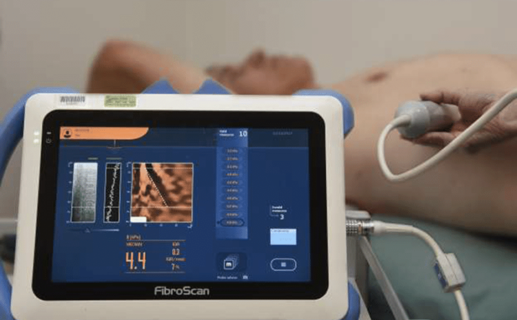  Fibroscan – A new simple method for early diagnosis of liver disease