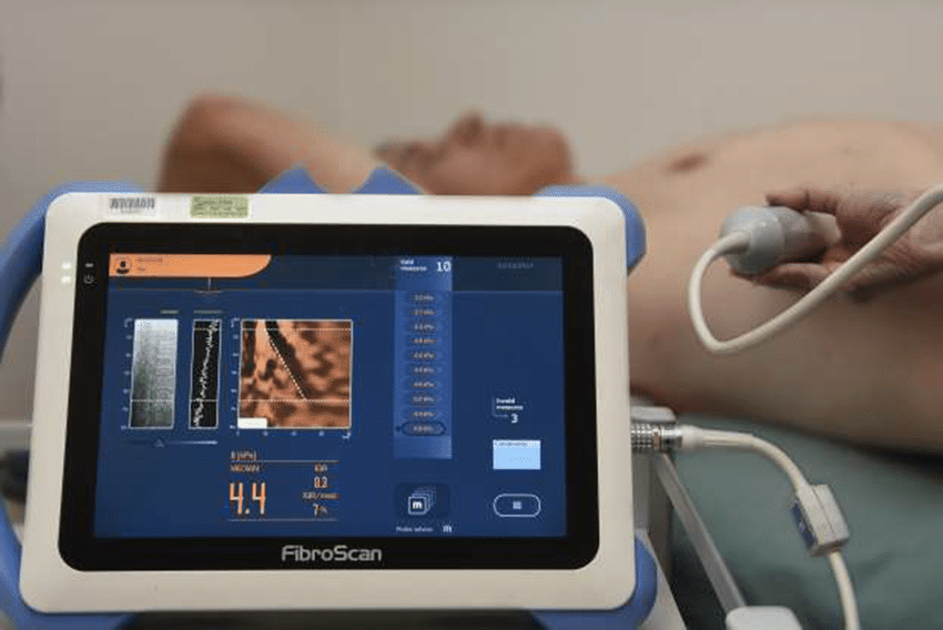 Fibroscan – A new simple method for early diagnosis of liver disease