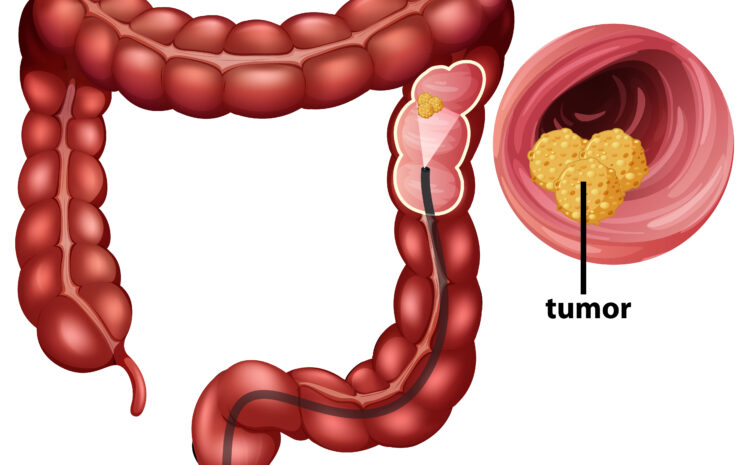  What Is Colon and Rectal Cancer (Colorectal Cancer)?