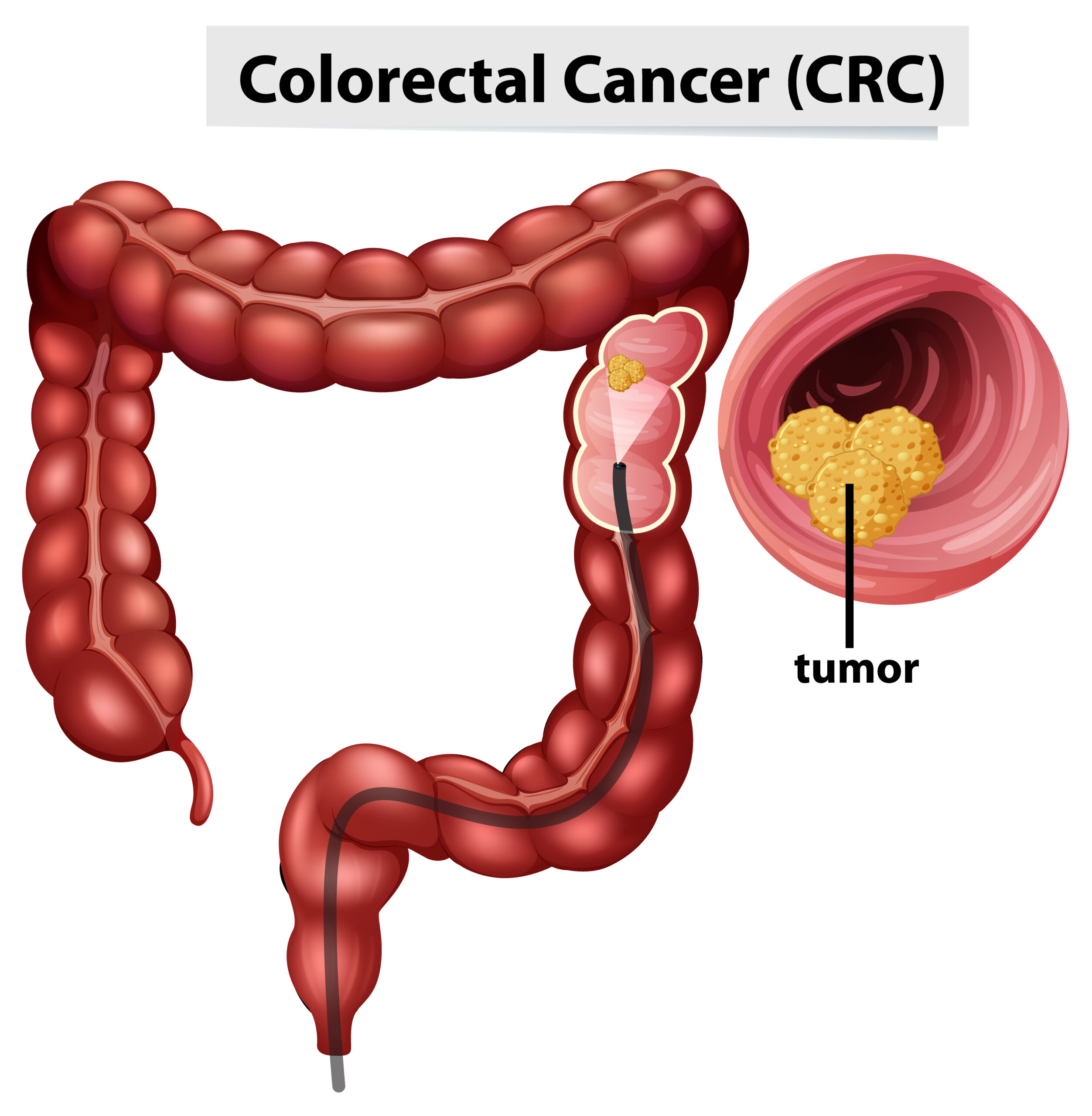 Brillar saber Céntrico Colon Cancer and Rectal Cancers - Dr. Ram Chandra Soni