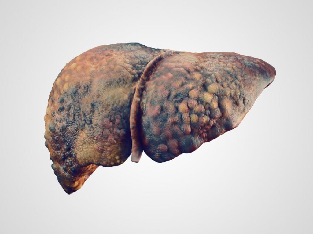 Alcoholic Liver Disease And How it’s Treated