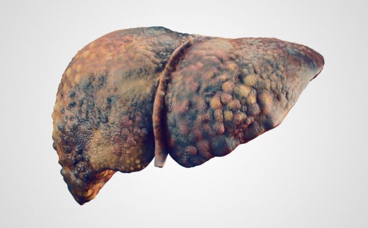  Alcoholic Liver Disease And How it’s Treated
