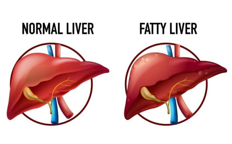  Best Hepatologist in Faridabad explains the Fatty Liver Disease