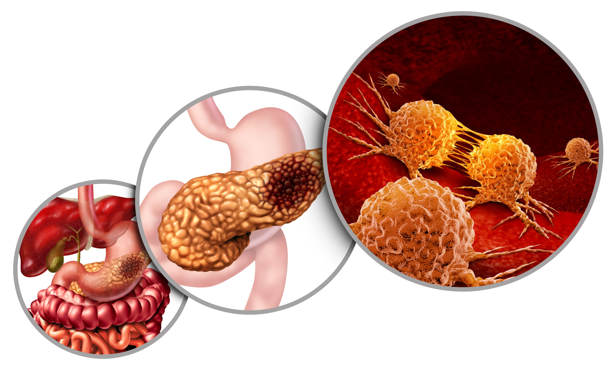 Pancreatic Cancer: Symptoms, Causes and Treatment