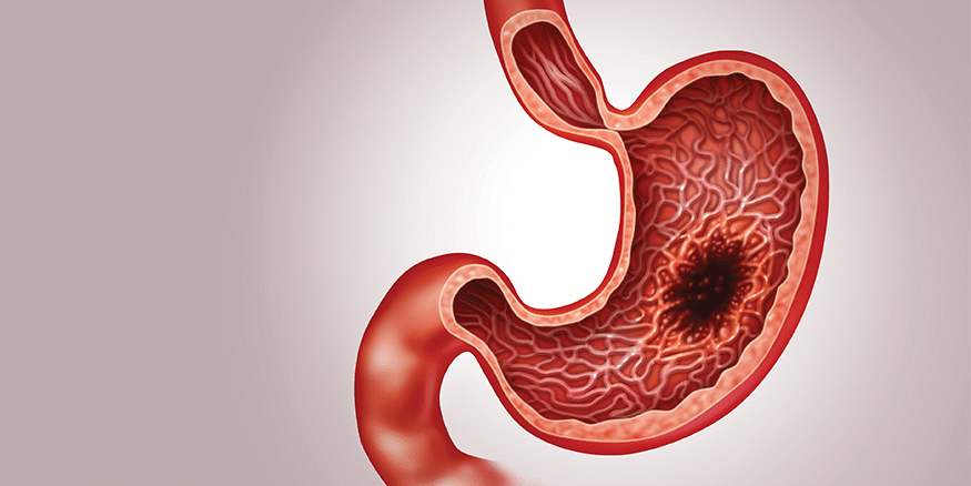 Gastrointestinal Cancer: Understanding the Risk Factors, Symptoms, and Treatment Options