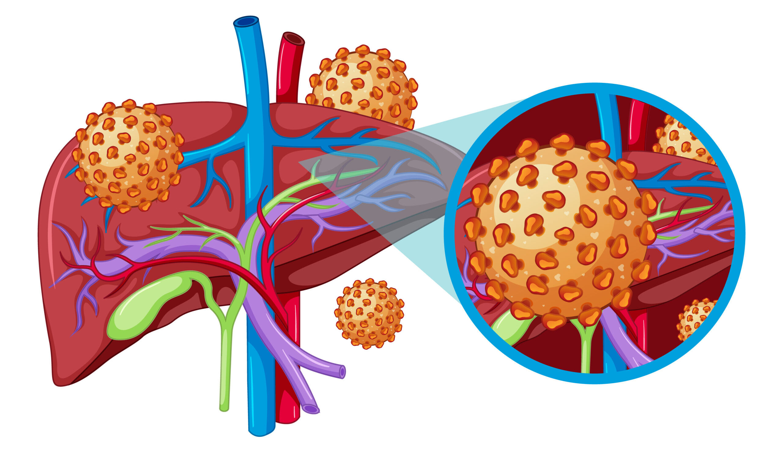 Hepatitis A – Causes, Symptoms, Treatment and Prevention