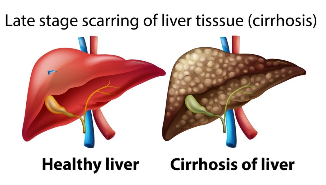 What is Cirrhosis of The Liver: Cause, Diagnosed and Treatment