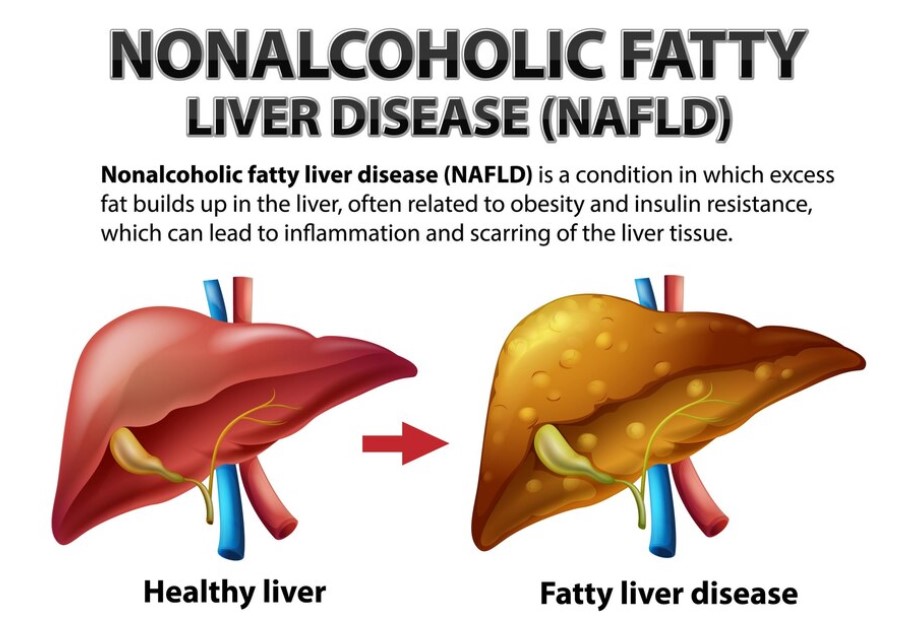 Non-Alcoholic Fatty Liver Disease (NAFLD): An Overview