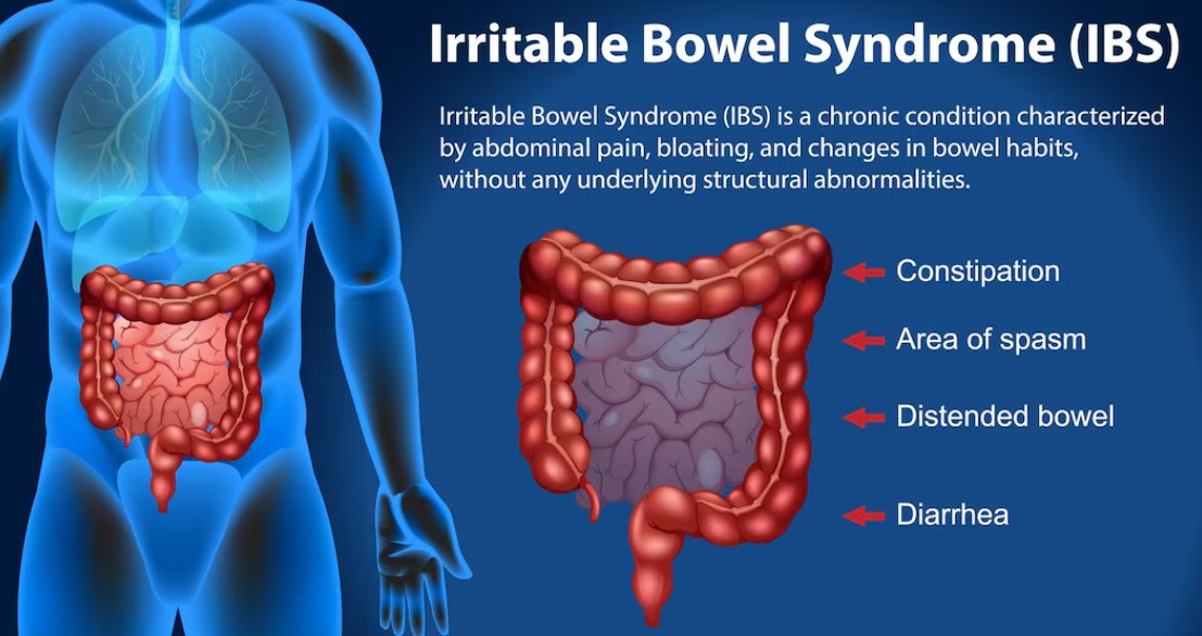 Managing IBS (Irritable Bowel Syndrome): Effective Treatment Options in Faridabad