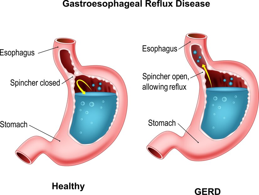 GERD Myths Debunked: Separating Fact from Fiction with Dr. RC Soni