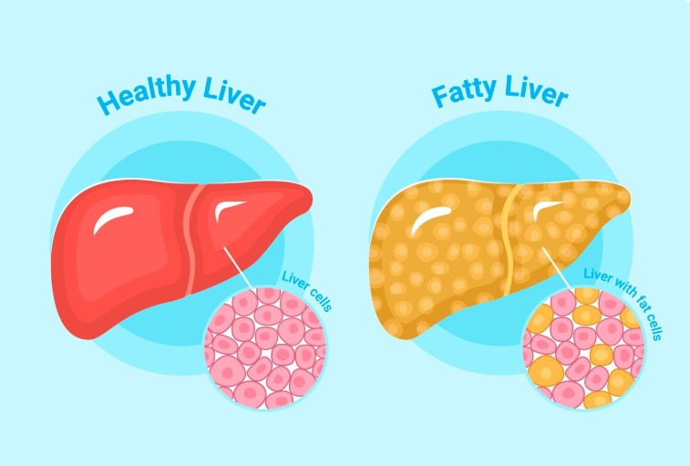 Understanding Fatty Liver: Causes, Symptoms, and the Road to Recovery