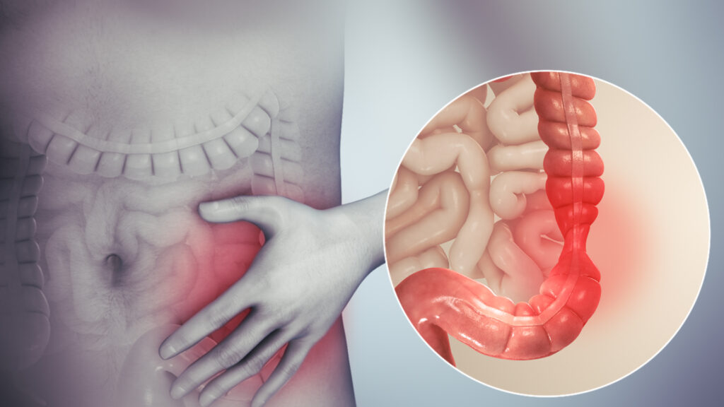 Irritable Bowel Syndrome (IBS): Symptoms and Management Tips